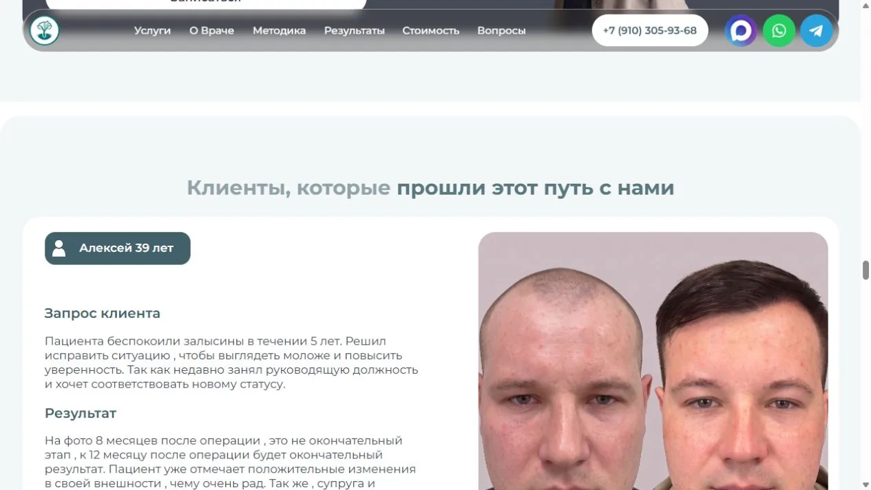 Кейсы пациентов до и после пересадки волос